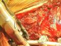 Posterior Spinal Instrumentation & Fusion for Idiopathic Scoliosis
