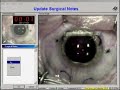 LASIK MY Left eye
