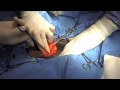 bladder stone removal