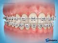 Decalcification (White Spots) After Braces