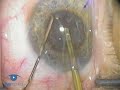Intraoperative Floppy Iris Syndrome (IFIS) Introduction Intraoperative Floppy Iris Syndrome (IFIS) Introduction