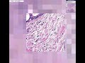 Histopathology Pancreas --Adenocarcinoma