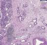 Histopathology Pancreas --Adenocarcinoma