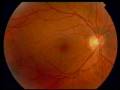 videos de Transplants_in_the_eye.mov