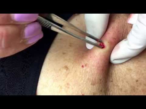 how to remove a mole
