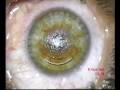 Laser Vision Correction Using an All-In-One Femtosecond Laser Procedure with the Visumax Laser