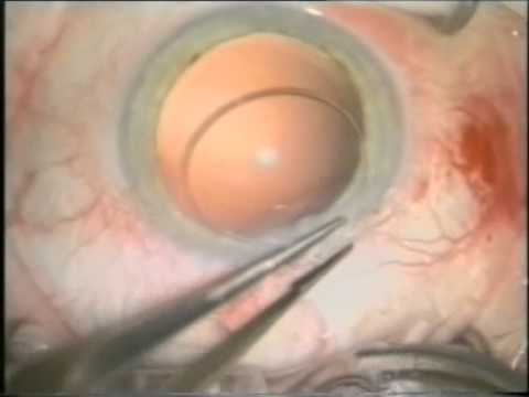 Ophtec Capsular Tension Ring 