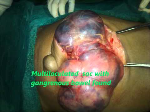 how to know if umbilical hernia is strangulated