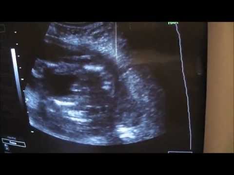 how to know baby gender without ultrasound