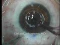 ICR (Keraring) Implantation with IntraLase