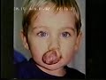 Hemangioma Forehead and treatment