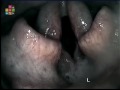 larynxparalyse;,stemband;,verlamming;