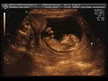 se viene el hijo o la hija del rini y la guada