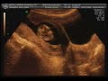 se viene el hijo o la hija del rini y la guada