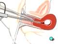 Malpractice Medical Myomectomy Vaginal Fibroid Removal Surgery 3