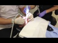 brads braces follow up needs a filling Acid erosion of the tooth enamel, causing demineralization that can move into the pulp of the tooth if not treated with fluoride or a filling