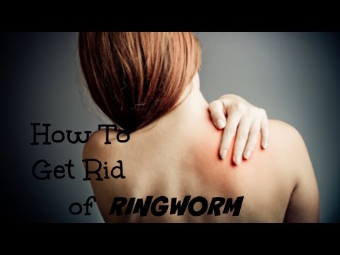 how to remove ringworm
