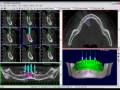 videos de Bioparts - Tutorial 8 DentalSlice: Ad. Implantes Parte1 de 2