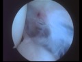 Tear Of The Capsule In Multiple Shoulder Displacement Tear Of The Capsule In Multiple Shoulder Displacement