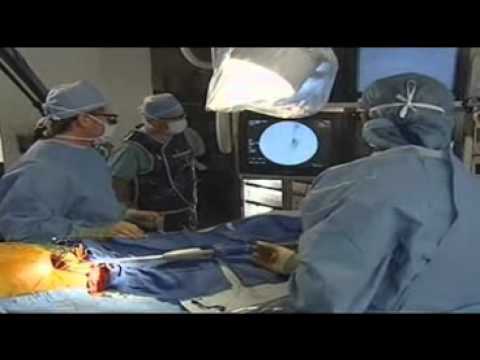 how to repair aortic aneurysm