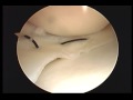 Vertical And Horizontal Stitch In Meniscus Correction Vertical And Horizontal Stitch In Meniscus Correction