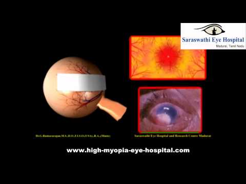 how to treat myopia