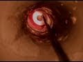 Ear Tubes (Placement, Removal, Replacement)