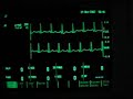 exercise ecg   maximum heart rate 180 beats per minute