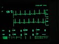 exercise ECG - maximum heart rate 180 beats per minute