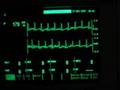 exercise ECG - maximum heart rate 180 beats per minute