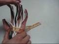videos de Sindrome del Tunel Carpiano UABC Medicina Mxl