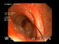 Pedunculated Polyp Removal From Colon Pedunculated Polyp Removal From Colon