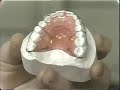 Diastema Closure