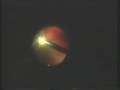 diabetic combined retinal detachment