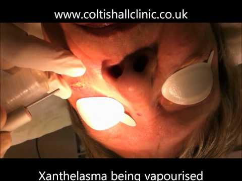 how to treat xanthelasma