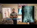 Mark-KIDNEY FAILURE-LOW BACK PAIN--LIFE ALTERING TESTIMONY-Abundant Life Chiropractic