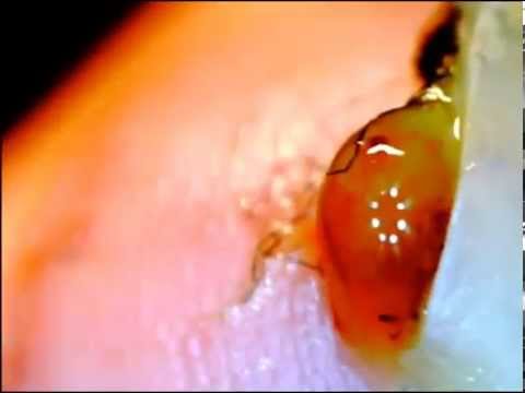 how to drain pus from toe