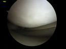 My Meniscus Surgery 1
