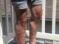 Traitement de varices