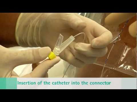 how to remove epidural catheter