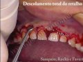Sorriso Gengival – Gengivoplastia (Gengivectomia Bisel Interno) – Periodonto.Net