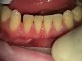 root coverage with alloderm.  this acelluar human donor collagen from the dermal layer can be used to augment gums instead of using tissue from elsewhere in the mouth.