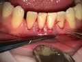 Root Coverage with AlloDerm