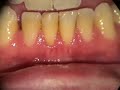 root coverage with alloderm.  this acelluar human donor collagen from the dermal layer can be used to augment gums instead of using tissue from elsewhere in the mouth.