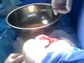 Removing Intestinal Worms and Parasites from a 3 Year Old