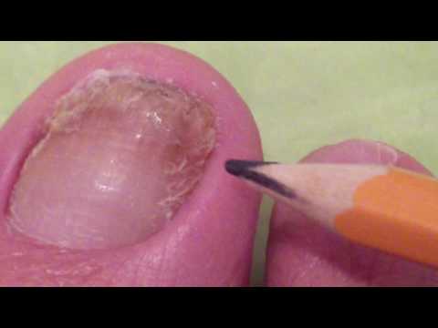 toenail