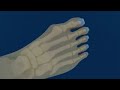 Bunion Surgery Explained Pain Hallux Abducto Valgus