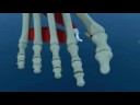 videos de Bunion Hallux Abducto Valgus Surgery - 02 - Podiatry Surgical Survey