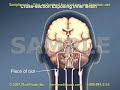 Medical Animation: Transient Ischemic Attack and Stroke Medical Animation: Transient Ischemic Attack and Stroke