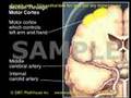 Medical Animation: Transient Ischemic Attack and Stroke